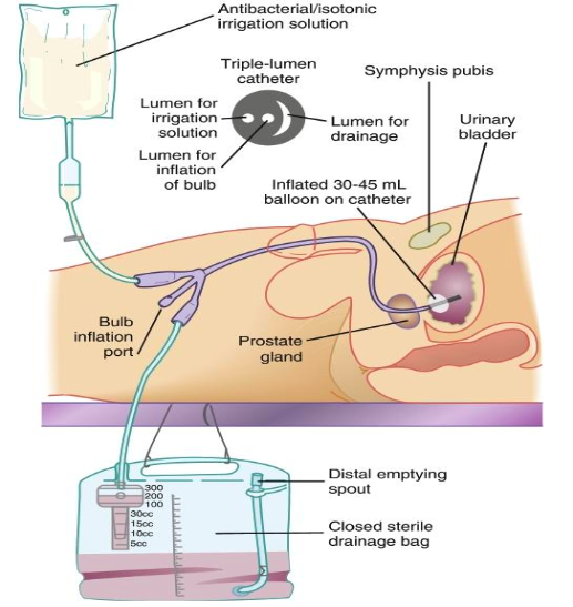 <p>one port for inflation, one for drainage,<strong> one for continuous bladder irrigation (CBI)</strong></p><ul><li><p>if had had urinary/ prostate surgery. for any big clots any big clots come out. flow rate is adjusted so drainage is light pink</p></li><li><p>volume going in has to be documented since that is not their urine output </p></li></ul><p></p>