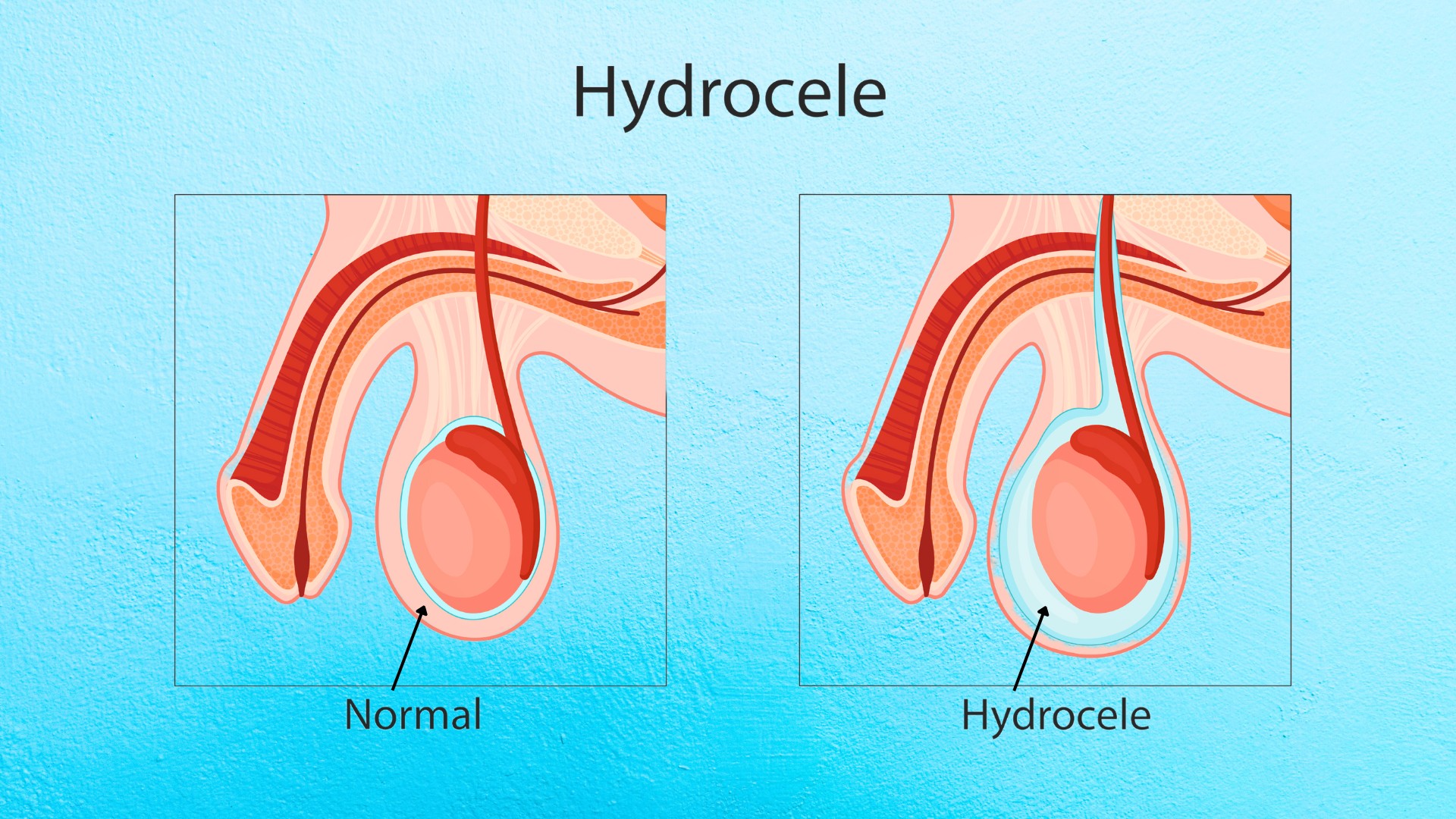 <p>Hydrocele</p>
