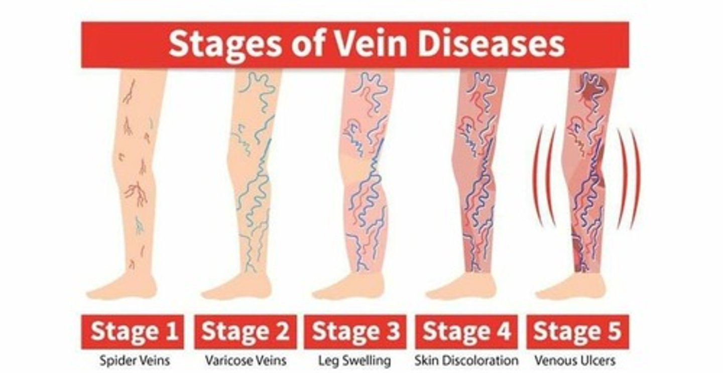 <p>Tortuous appearance of superficial veins</p><p>Occurs in lower limbs dt gravity - i.e. valves work harder</p><p>Valves damaged -&gt;swelling -&gt;discoloration (blue/purple) -&gt;surrounding skin becomes darker dt venous insufficiency</p><p>Cx's:</p><p>Pregnancy</p><p>Medication</p><p>Long standing periods</p><p>Spider veins - same process but smaller vessels walls are affected bcoz they have no valves</p>