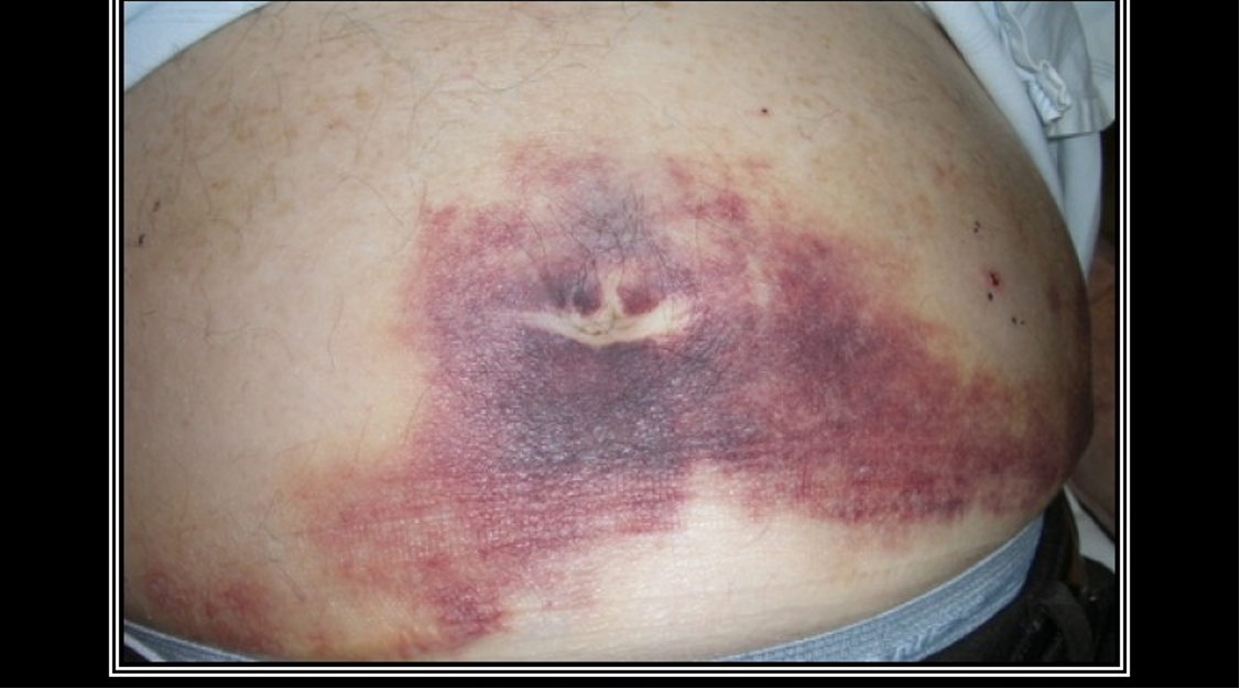 <p>Blue discoloration to umbilicus form retroperitoneal bleeding in pancreatic necrosis </p>