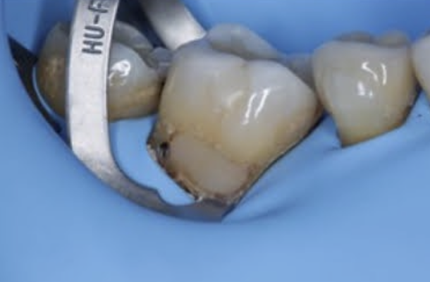 <p>Which clamps are used to provide access if Rubber Dam is used?</p>