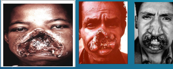 <ul><li><p>also called <strong>espundia</strong>, begins with a papule at the site of insect bite, then forms metastatic lesions, usually at the mucocutaneous junction of the nose and mouth</p><ul><li><p><u>Disfiguring granulomatous, ulcerating lesions destroy the nasal cartilage </u><strong><u>(tapur nose) </u></strong>but not the adjacent bone.</p></li><li><p>Death can occur from secondary infections.</p></li></ul></li></ul><p></p>