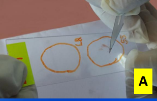 <p>Demonstration of amastigotes by light microscopic examination of Giemsa stained lesion material</p>