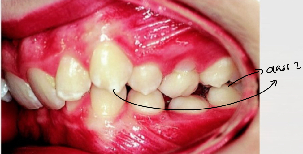 <p>Retroclined upper central incisors- lateral can be proinclined or normal </p><p>Overjet minimal or increased </p>