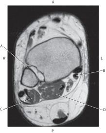 <p><mark data-color="blue">Which line is pointing to the flexor hallucis longus muscle?</mark></p>