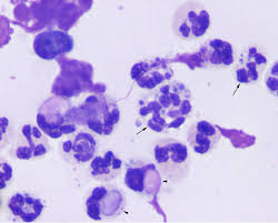 <p>Neutrophils w/ precipiated RF, indicates RA</p>