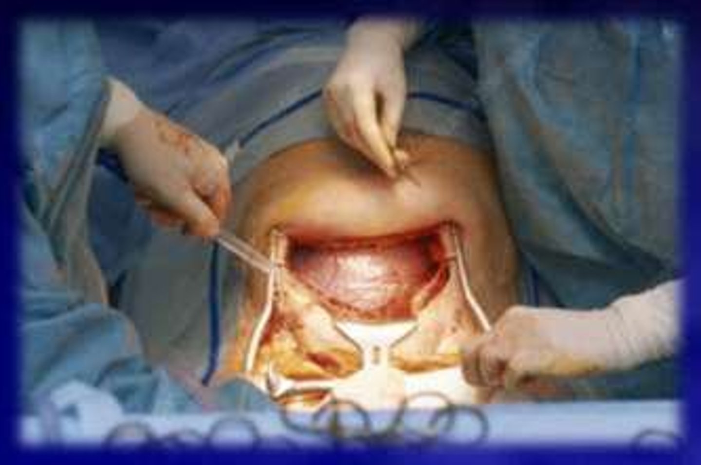 <p>Surgical removal of fetus through abdomen.</p>