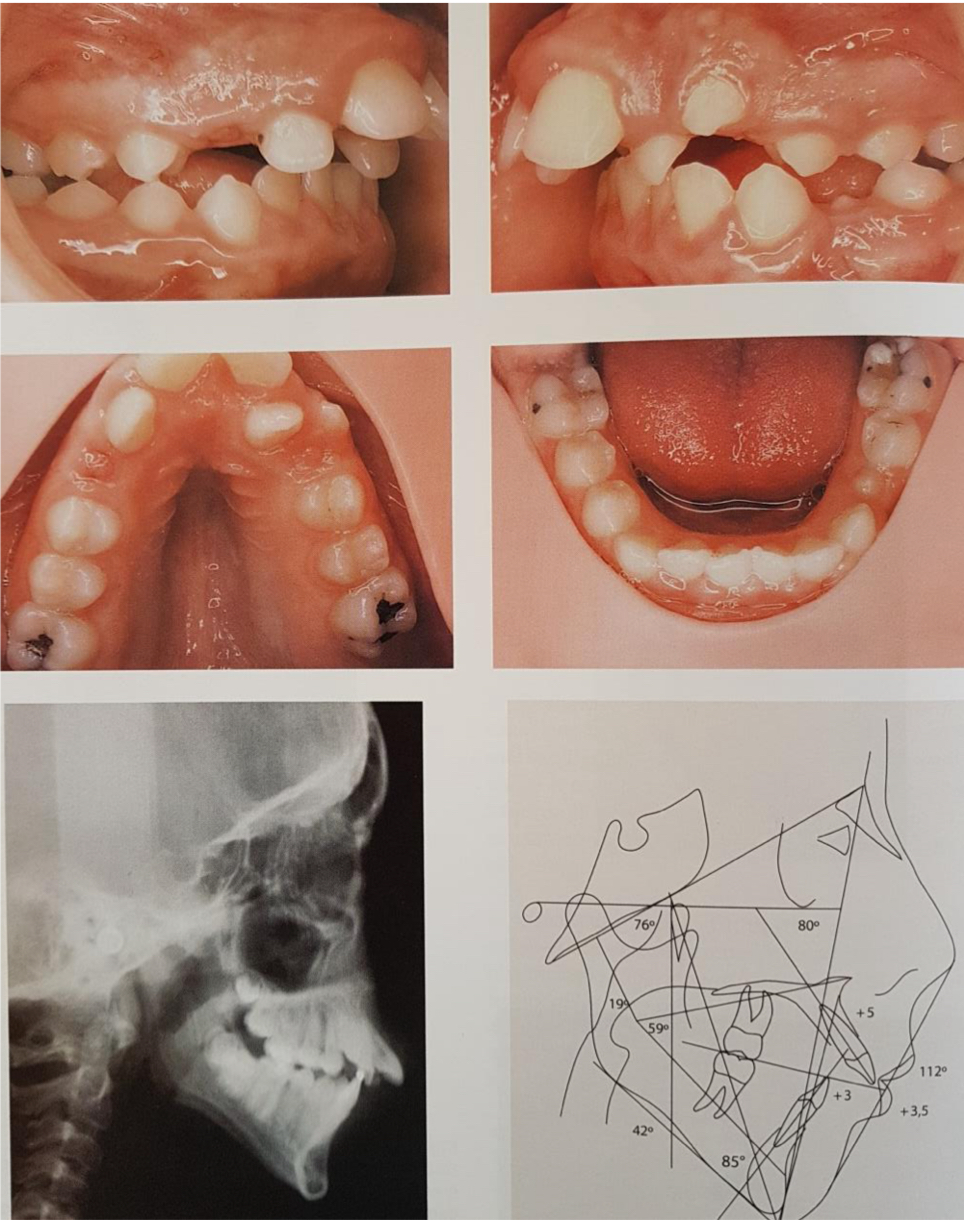 <p>Protrusion of maxillary incisors</p><p>Decreased transversal development</p><p>Posterior crossbite</p><p>Anterior openbite</p><p>Chronic marginal gingivits</p>