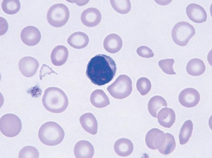 <p></p><ul><li><p>Low MCV</p></li><li><p>Low reticulocyte count</p></li><li><p>High RDW</p></li><li><p>Low Serum Ferritin </p></li><li><p>Transferrin (TIBC) increases</p></li><li><p>Blood Smear - microcytic, hypochromic (pale RBCs); aniso- & poikilocytosis</p></li></ul><p></p>