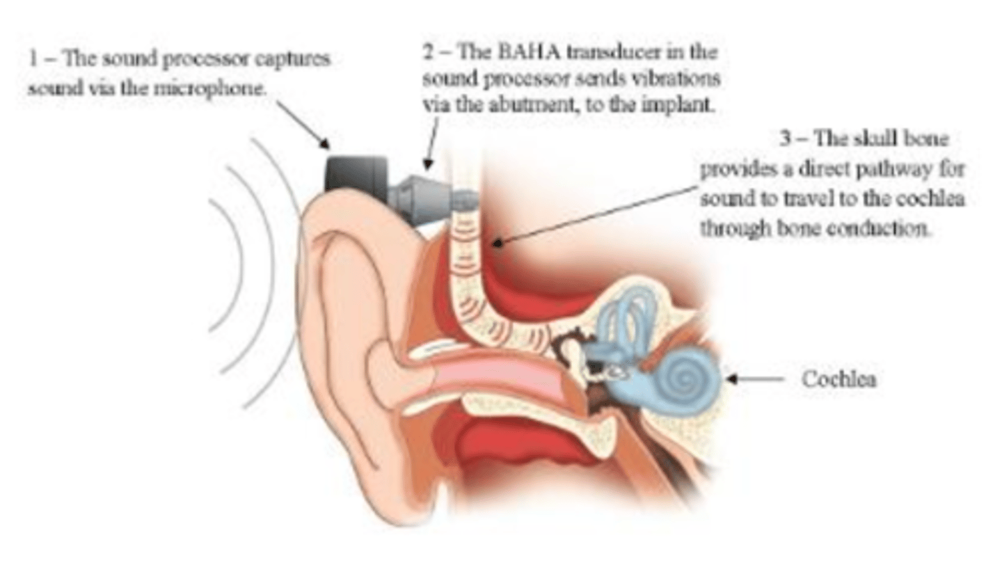 <p>bone-anchored hearing aid</p>