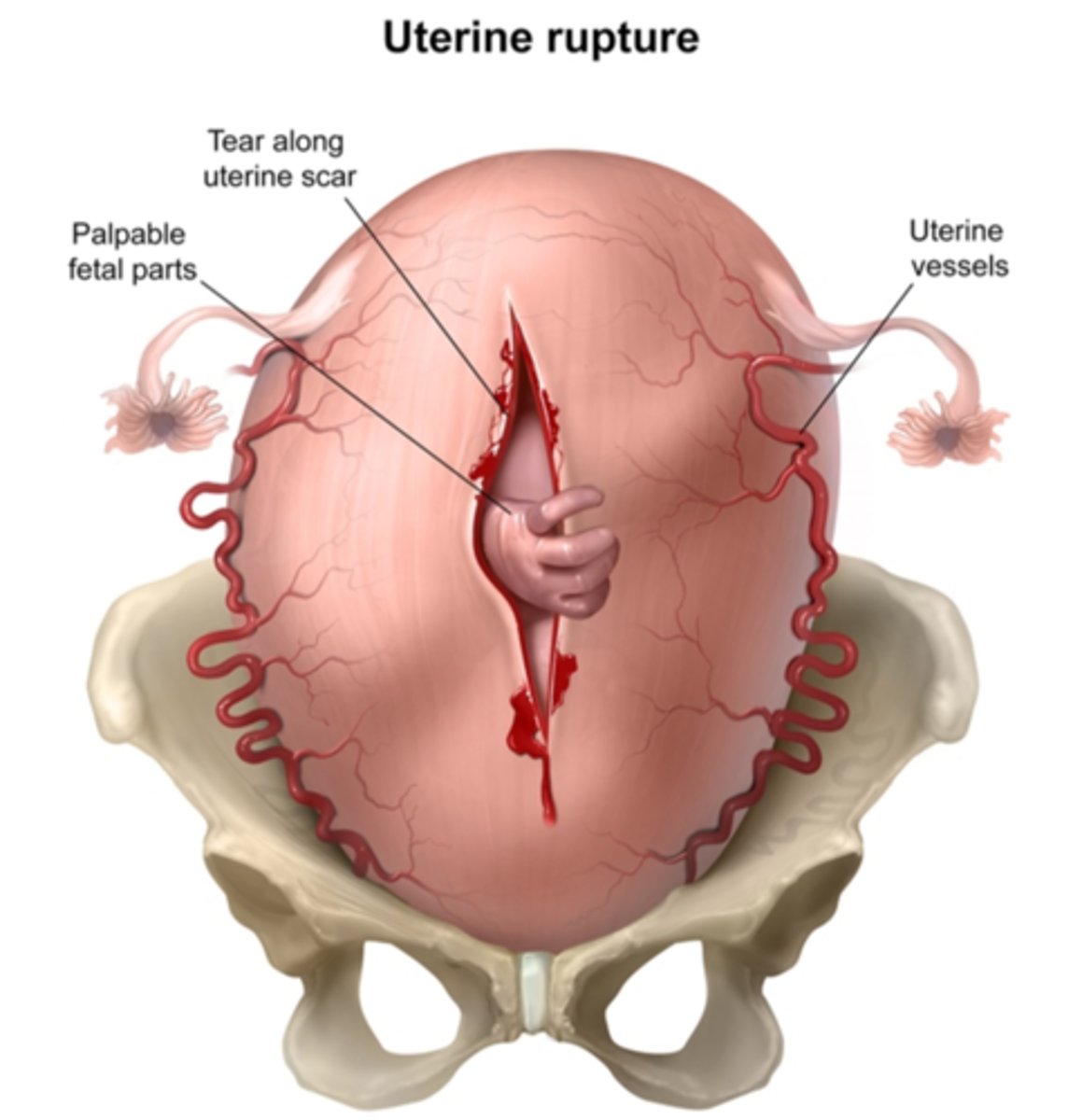 <p>tear in the uterine lining secondary to increased pressure</p><p>Risk factors</p><p>Prior uterine surgery</p><p>More common in C sections</p><p>Trial of labor after cesarean (TOLAC).</p><p>Signs</p><p>Sudden development of a category II or category III fetal heart rate pattern</p><p>Weakening contraction</p><p>Symptom</p><p>Abdominal pain</p>