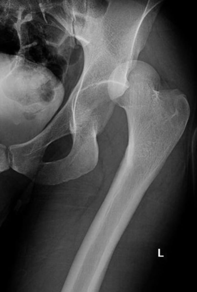 <p>Trauma pt comes in s/p MVC. VSS. Pt CC is hip pain. nSuperior and lateral to the acetabulum. What's going on?</p>