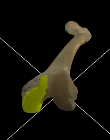 <p>Grote knobbel aan de mediale zijde voor articulatie met de tibia.</p>