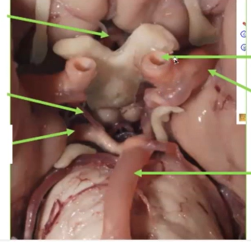 <p>bulging of the artery</p>