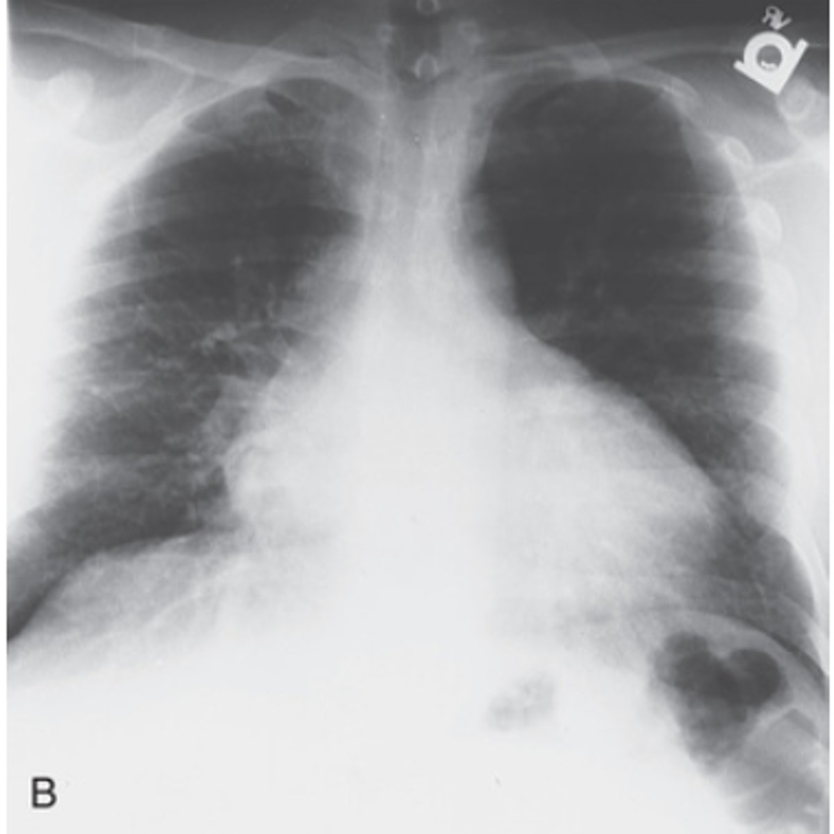 <p>Multi-chamber dilation</p>