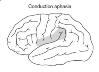 <p>production/comprehension preserved, repetition impaired</p>