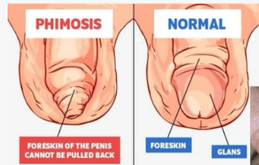 <p><strong>Phimosis</strong></p><p>-_____ prepuce over the glans penis that is ________ to be retracted</p><p>-Normal in ______ and toddlers</p><p>-In older children and adults, can be caused by _________, infection, or inflammation. Difficult to keep clean</p>