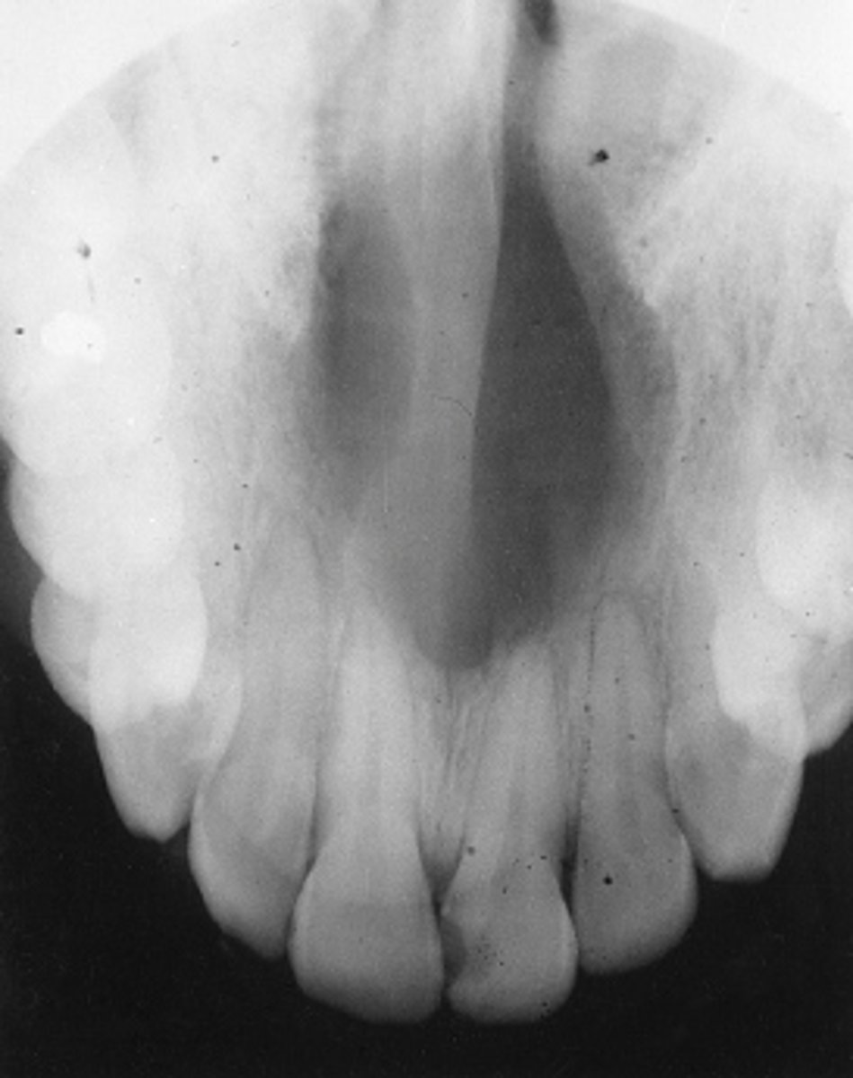 <p>median palatine</p><p>A median palatine cyst is a well-defined unilocular radiolucency located in the midline of the hard palate. A nasolabial cyst is a soft tissue cyst with no alveolar bone involvement. A globulomaxillary cyst is a well-defined, pear-shaped radiolucency found between the roots of the maxillary lateral incisor and cuspid. A branchial cleft cyst is located on the lateral neck at the anterior border of the sternocleidomastoid muscle.</p>