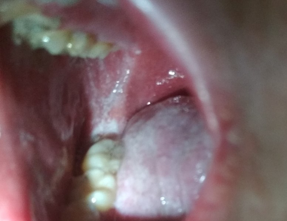 <ul><li><p>Prodromal symptoms (pyrexia and cough)</p></li><li><p>Fever over 40 degrees </p></li><li><p>Coryzal symptoms </p></li><li><p>Conjunctivitis </p></li><li><p>Koplik spots→ small grey discolourations in the mouth </p></li><li><p>Rash appears behind ears then spreads to trunk and limbs over 3-4 days </p><img src="blob:null/e5127c78-26eb-4465-b47a-26960c8b644f"></li></ul><p></p>