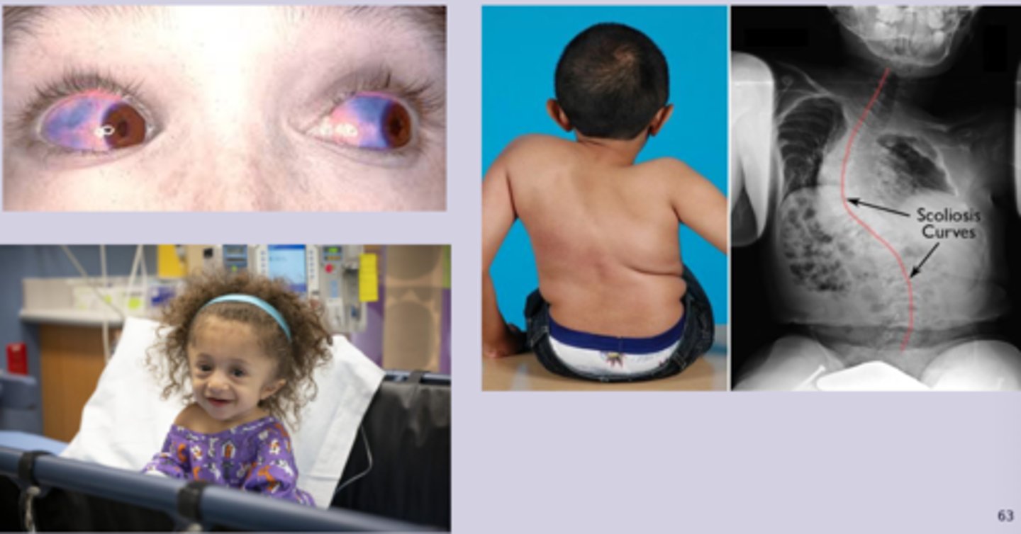 <p>-multiple fractures throughout life with minimal or no trauma </p><p>-bone pain</p><p>-short stature and growth delay</p><p>-easy bruiding, excessive sweating </p><p>-dental problems</p><p>-blue or gray sclera</p><p>-bone deformities, hearing loss, triangular facies</p><p>-type 1: normal stature, blue sclera, hearing loss </p>