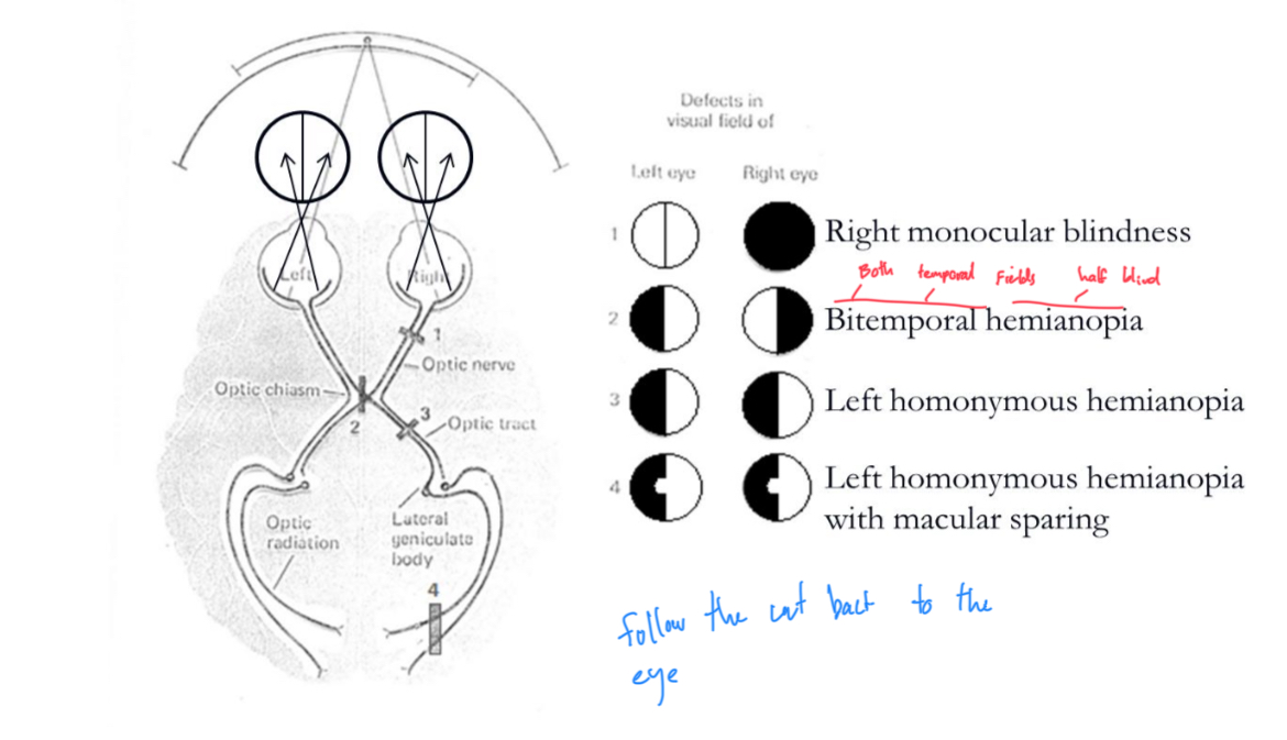 <p>Visual field loss on sides of both eyes, often resulting from damage to the optic tract or visual cortex.</p>