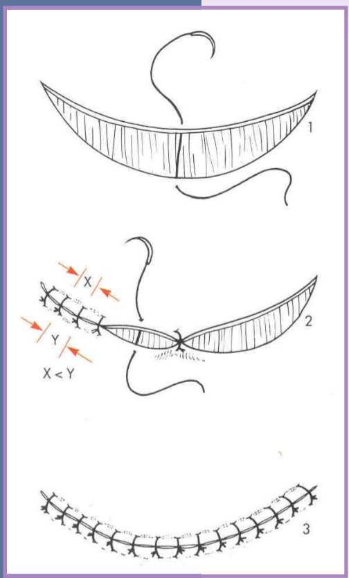 <p>crescentic skin defects </p>