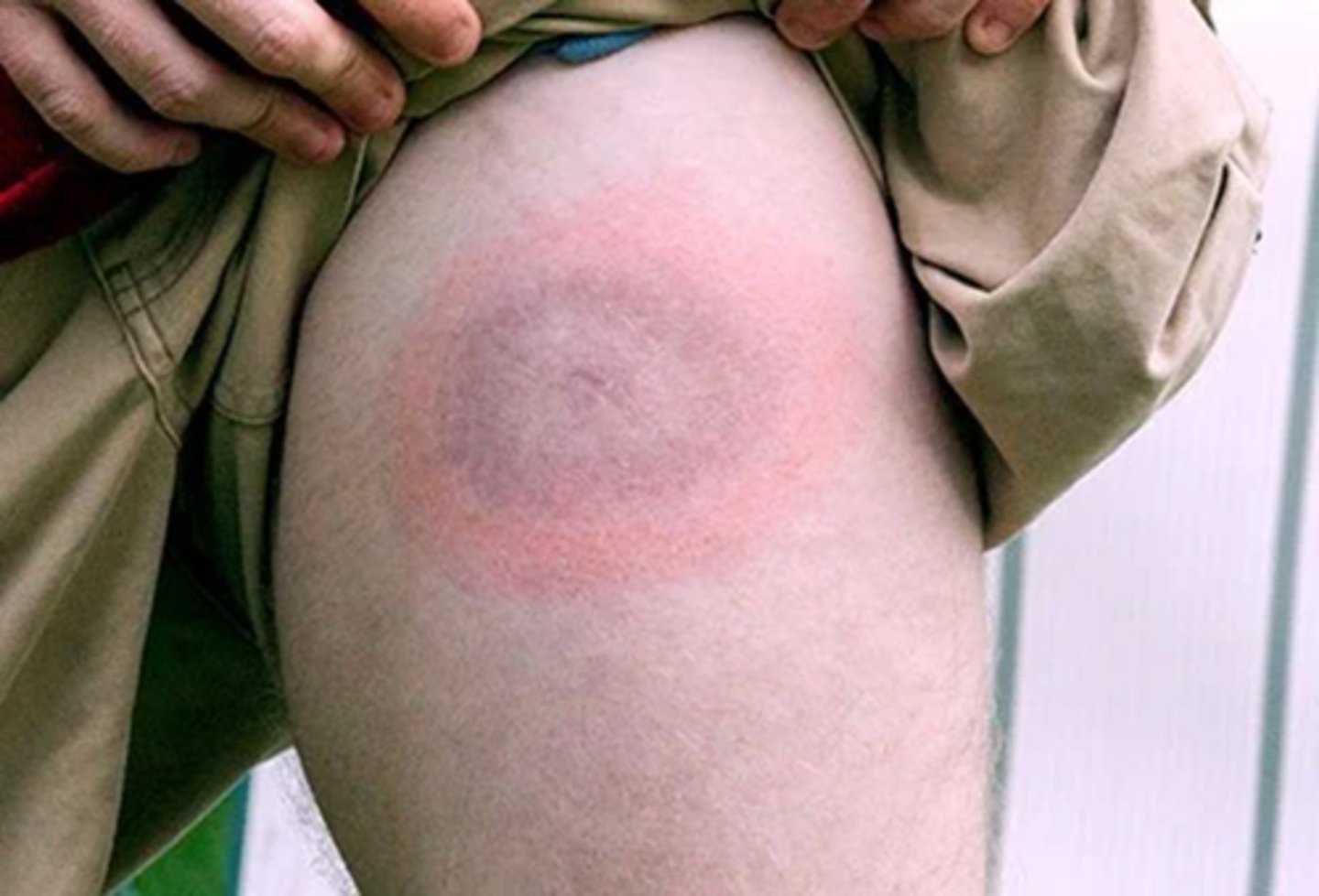 <p>erythema migrans (EM) "bull's eye" rash</p>