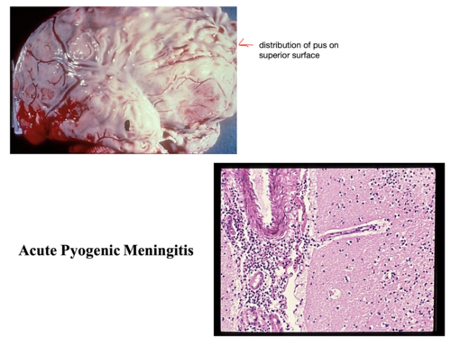 <p>remember -> neutrophils form pus</p>