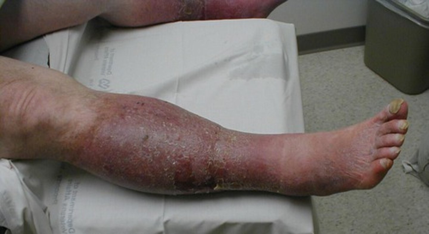 <p>persistent ambulatory lower extremity venous hypertension</p>
