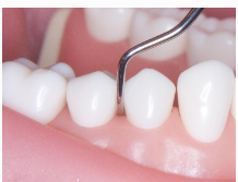 <p><span><strong> The lower shank is parallel to the distal surface.</strong></span></p><p><span><strong> The functional shank goes “up and over” the tooth.</strong></span></p><p><span><strong> Instrument handle comes “outside the </strong></span><strong>mouth”</strong></p>