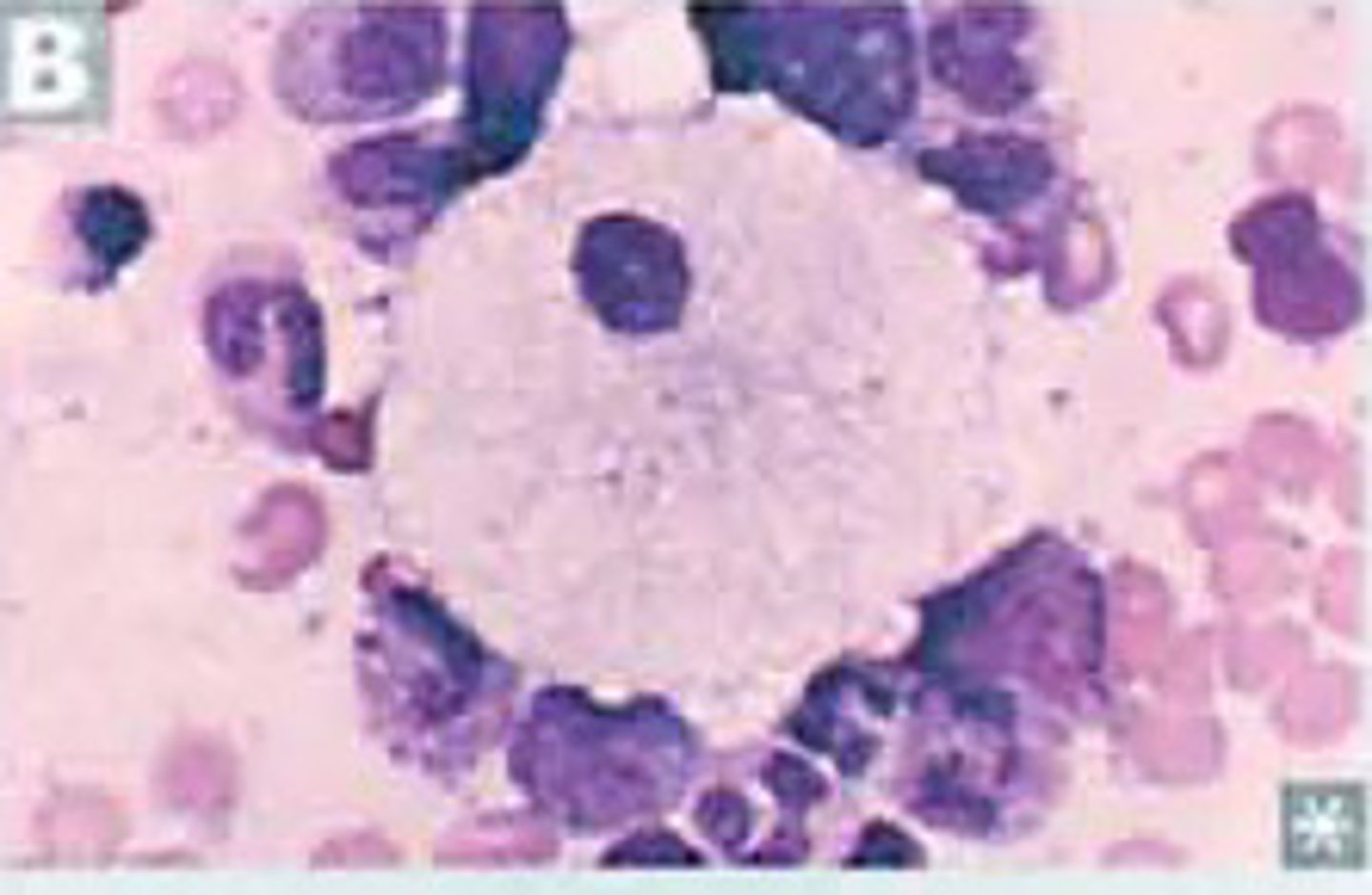 <p>Niemann-Pick disease</p><p>(genetic sphingomyelinase deficiency)</p><p>Foam cells</p>