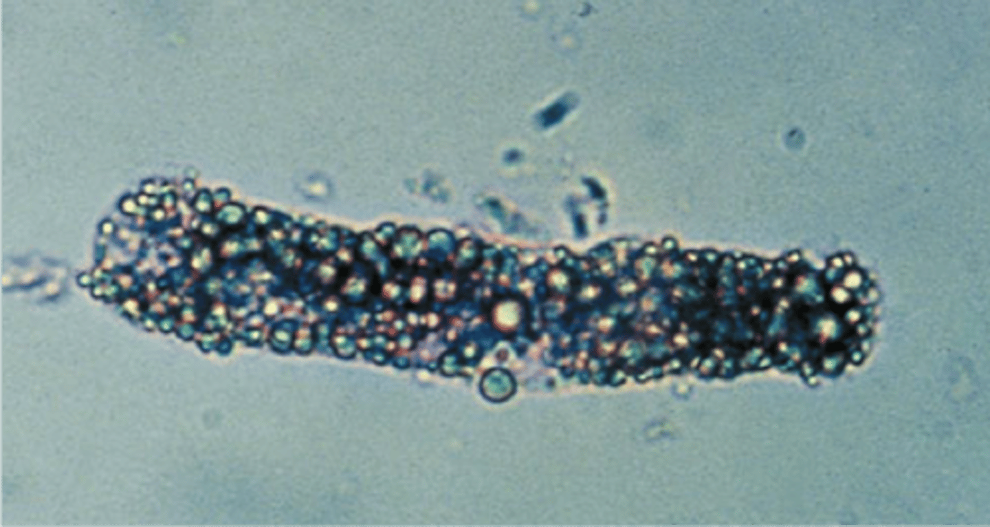 <p>highly refractile with the appearance of oil droplets on the cast matrix, as shown in the top image on the right. containing cholesterol will produce classic Maltese cross formations under polarized light. Are characteristic of degenerative tubular disease and are frequently associated with heavy proteinuria.</p>