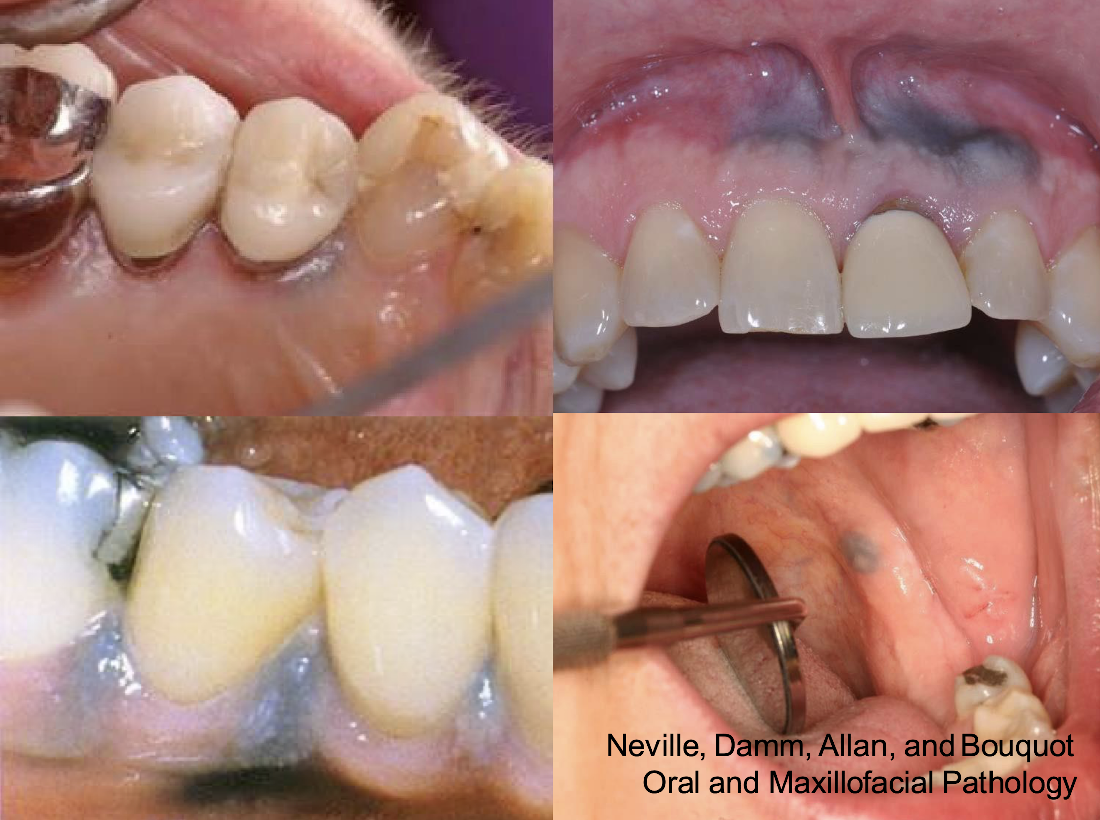 <p>which pigmented lesion?</p><p>clinical features </p><ul><li><p>Asymptomatic, localized</p></li><li><p>Blue-gray macule</p></li><li><p>Gingiva/alveolar ridge mucosa (50%)➔ buccal mucosa ➔floor of mouth</p></li><li><p>Localized around areas with: (blank) restoration</p></li></ul><p></p>