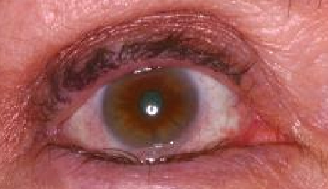 <p>What type of eyelid position condition is this?</p>