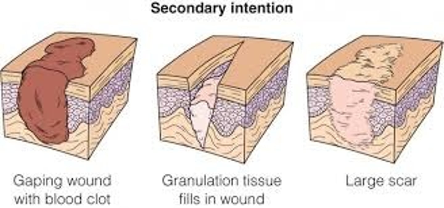 <p>Large, contaminated wounds that heal with major tissue loss</p>