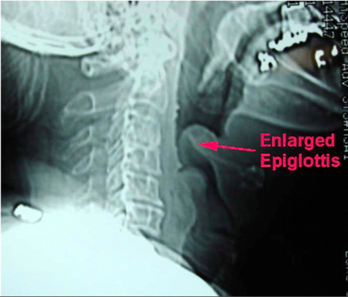 <p>soft tissue shadow looks like a thumb pressed into trachea - cause by a swollen and oedematous epiglottis</p>