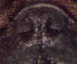 <p><span>Brachycephalic Airway Syndrome</span></p>