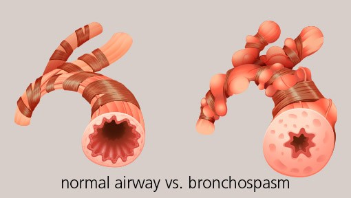 a contraction of the smooth muscle in the walls of the bronchi and bronchioles that tighten and squeeze the airway shut
