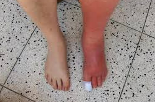 <ul><li><p><strong>Bacterial Infection:</strong></p><ul><li><p>Localized infection and inflammation of the skin and subcutaneous tissues, usually preceded by skin trauma.</p></li><li><p><strong>Cause:</strong> <em>Streptococcus</em> or <em>Staphylococcus</em> bacteria may enter via an abrasion, laceration, insect bite, foreign body, or infected lesion.</p></li></ul></li><li><p><strong>Localized Reactions:</strong></p><ul><li><p>Erythema</p></li><li><p>Pain</p></li><li><p>Edema</p></li><li><p>Warmth at the site of skin disruption</p></li></ul></li><li><p><strong>Education</strong>:</p><ul><li><p>Mark around the border to see if it getting worse → sepsis.</p></li></ul></li><li><p><strong>Treatment:</strong></p><ul><li><p>Mild cases treated with <em>Cephalexin</em> or <em>Augmentin</em></p></li><li><p>More severe cases of orbital cellulitis may require IV management.</p></li></ul></li></ul><p></p>