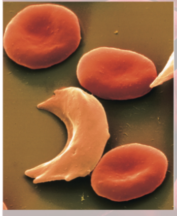 <p>Hereditary hemoglobin defects</p><p>Caused by recessive allele, modifies structure of hemoglobin</p><p>Hemoglobin does not bind oxygen well</p><p>clump together and can block blood vessels—intense pain</p><p>risks: kidney/heart failure, stroke, or paralysis</p>