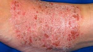 <p><span>Area of thickening of the skin caused by chronic scratching. The normal skin lines are easier to visualize.</span></p>