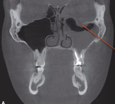 <p>look for “trap door”</p><ul><li><p>inferior orbit breaks because it is the weakest</p></li></ul><p></p>