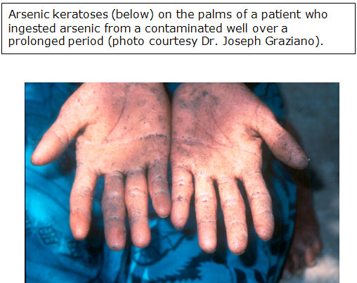 <p>Chronic Poisoning Effects!! </p>