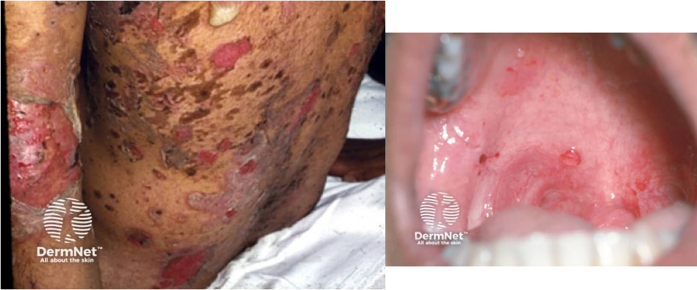 <ul><li><p>intraoral blisters and erosions</p></li><li><p>cutaneous lesions- vesicles, erosions, bullae</p></li><li><p>pos nikolsky sign</p></li><li><p>heals w/o scarring</p></li><li><p>location: mouth (MC), genitalia, face, scalp, trunk, groin, axilla</p></li></ul><p></p>