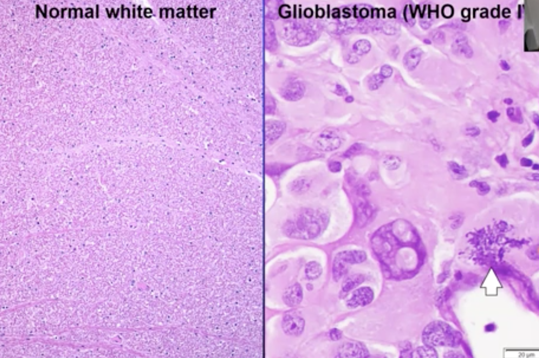 Glioblastoma (tumour of the precursors of glial cells). Arrow points are multiple mitosis processes happening at the same time in one cell 