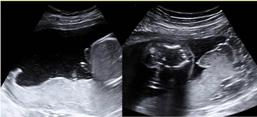 <p>a circumvallate placenta</p><p>a) causes placental thickening assoc w/fetal hydrops </p><p>b) is caused by back folding of the placenta + fetal membranes toward the chorionic surface</p><p>c) is commonly assoc w/chromosomal anomalies</p><p>d) causes placental insufficiency + IUGR </p>