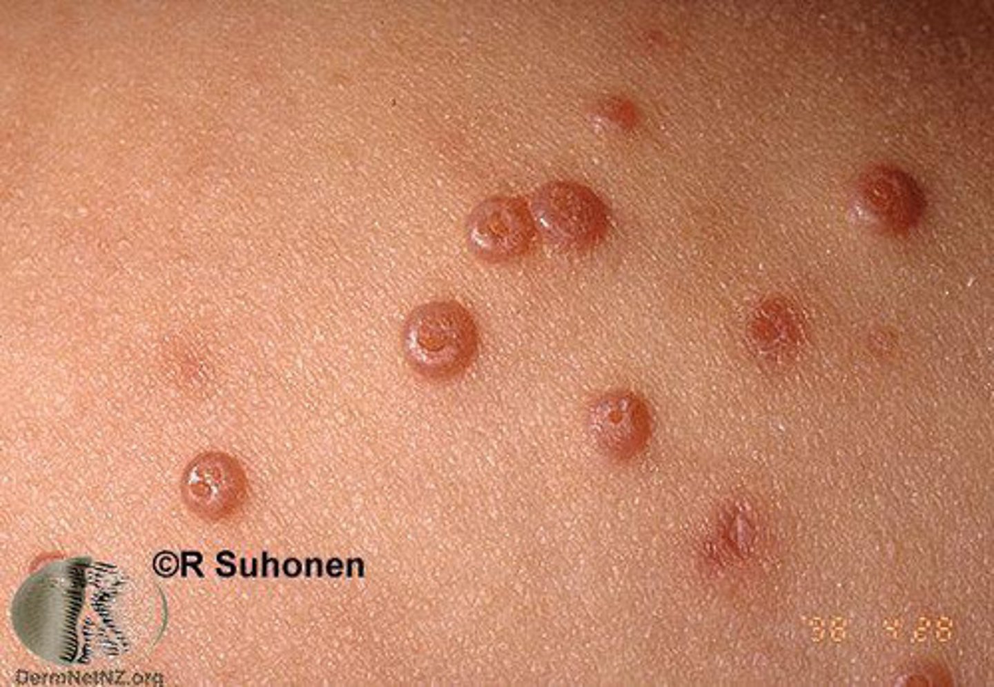 <p>smooth, waxy nodules on the face, trunk and limbs</p><p>- can be disfiguring to immunocompromised</p>