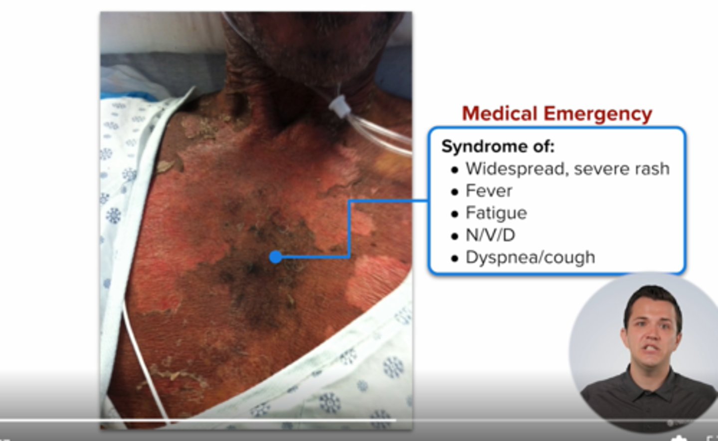 <p>risk for hypersensitivity reaction (HSR)</p><p>must test prior for</p><p>hlab5701</p><p>pts must carry card indicating HSR (fever, rash, nvd, dyspnea, cough) are emergency</p><p>never rechallenge pts with hsr symptoms</p>