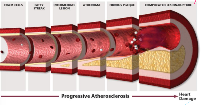 <p>• Largely caused by atherosclerosis, plaque formation</p><p>• Made up of lipids, cell debris, foam cells (macrophages that engulf cholesterol), calcium</p><p>• Covered by fibrous cap made up of collagen and smooth muscle cells</p><p>• Lumen narrows and blood flow is reduced, plaque can break off into a clot</p>