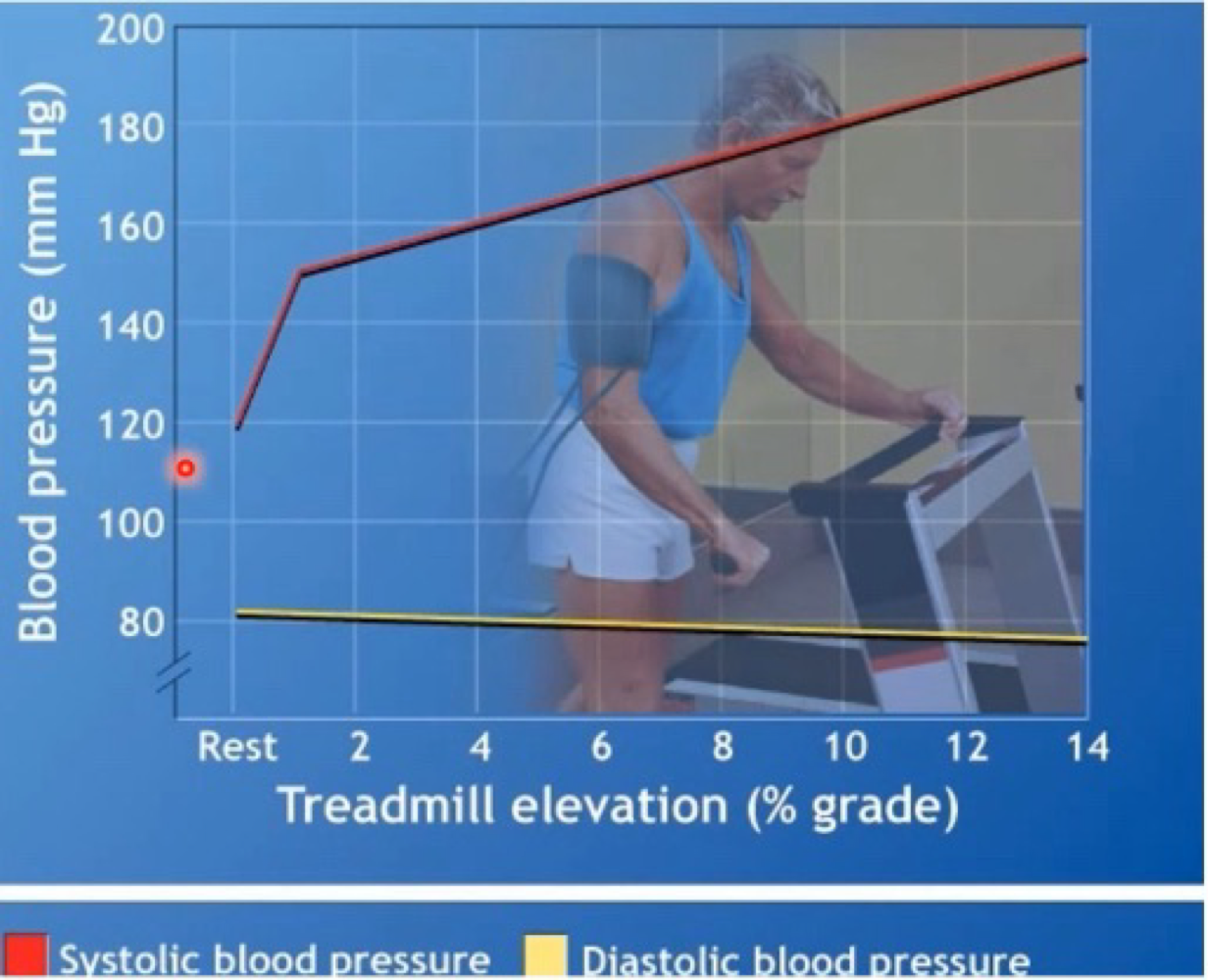 <ul><li><p>Linear increase in SBP proportional to workload </p></li><li><p>SBP can &gt; 200mmHg of higher during max exercise = most likely sue to a large cardiac output (increased venous return = increased cardiac output = increased blood flow)</p></li><li><p>DBP remains relatively stable during exercise </p></li></ul><p></p>